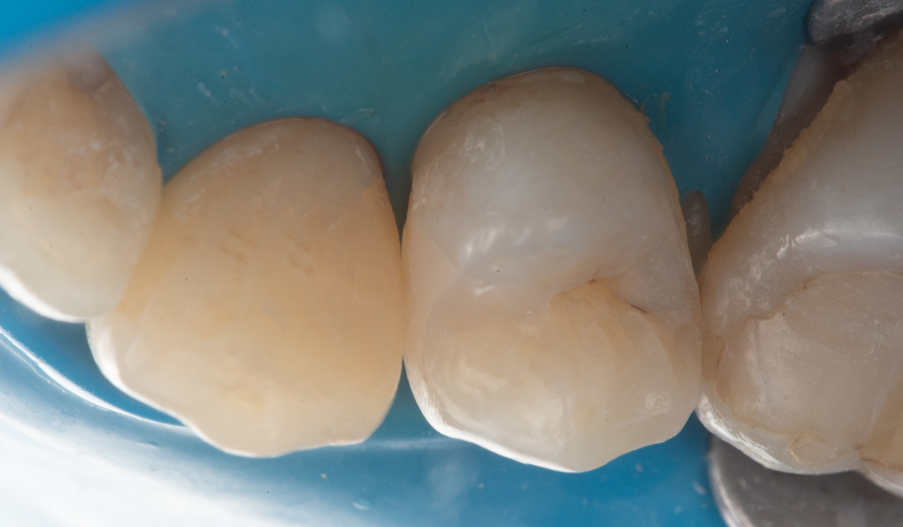 Fig. 10: Occlusal view of the final restorations of teeth #23 and #24, showing colour blending, anatomical form, and surface gloss.